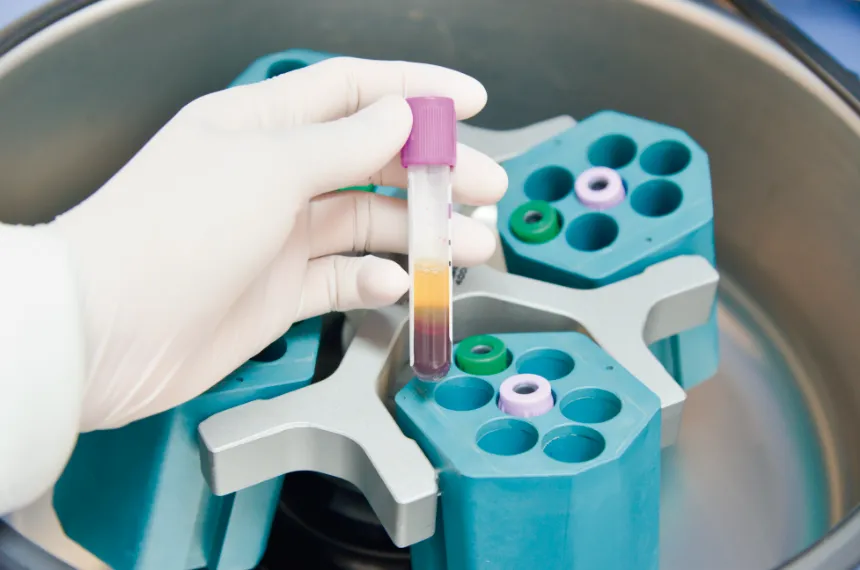 Plasma rico en plaquetas (PRP). Qué es y cuál es el método