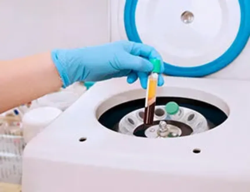 Cómo se prepara y almacena el plasma rico en plaquetas: Procesos y protocolos